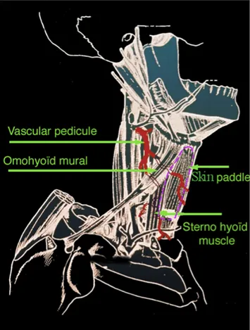 Figure 3. Infra hyoid musculo-cutaneous flap. Surgical aspect, front view.