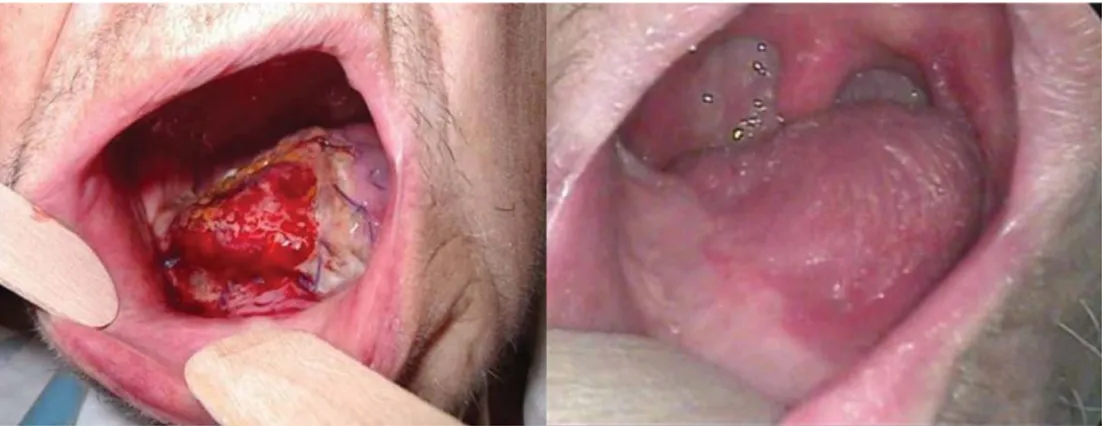FIGURE 1. An 83-year-old woman with T4aN0 oral tongue squamous cell carcinoma treated with pull-through resection encompassing three fourths of the mobile tongue, ‘‘en bloc’’ modiﬁed radical neck dissection, infrahyoid ﬂap reconstruction