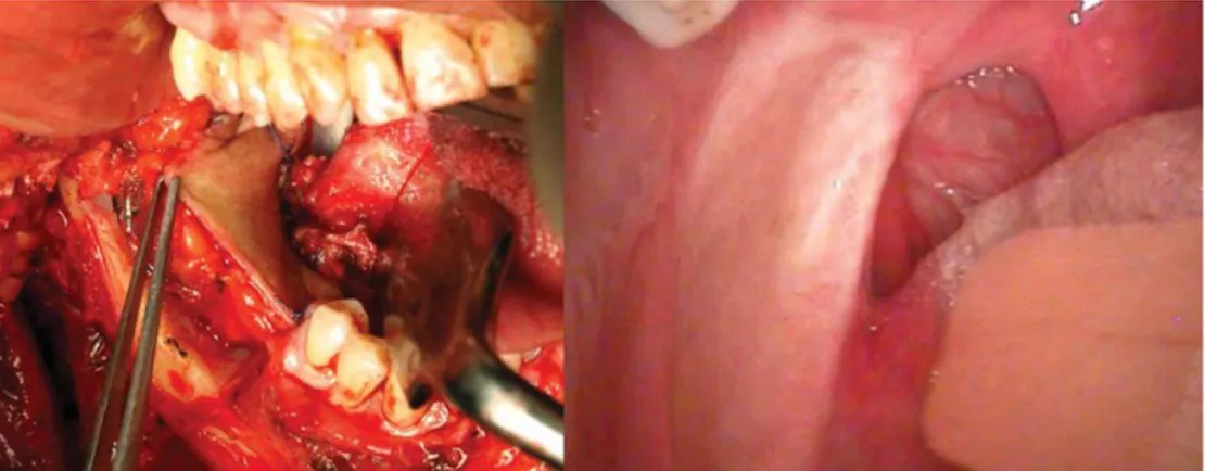 FIGURE 3. Infrahyoid ﬂap reconstruction of the right tonsillar region, soft palate, and retromolar trigone