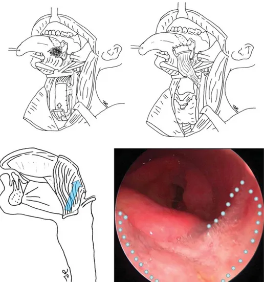 FIGURE 4. Base of tongue reconstruction after transmandibular resection of pT3N1 SCC at the left hand side