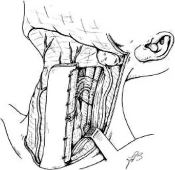 FIGURE 2. The tendon of the omohyoid muscle is divided and subfascial dissection is carried on toward the ﬂap.