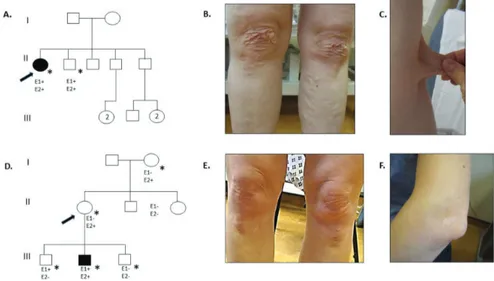 Figure 1. Pedigrees and clinical photographs of probands 1 and 2. (A) Family pedigree of proband 1