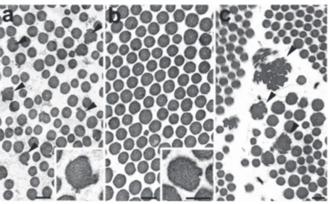 Figure 2. Electron micrographs of the reticular dermis of skin biopsy from proband 1 (a), proband 2 (b) and a case of classical EDS (c)