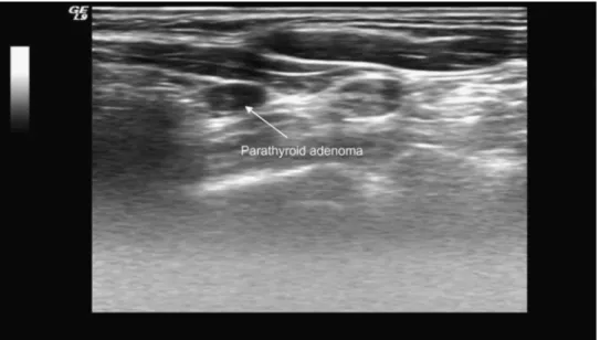 Figure 1. Ultrasound investigation: hypoechoic tissue suggestive of parathyroid adenoma.
