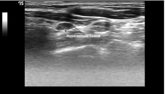 Figure 2. Ultrasound features after the first ‘step’: hyperechoic image all around the parathyroid adenoma.