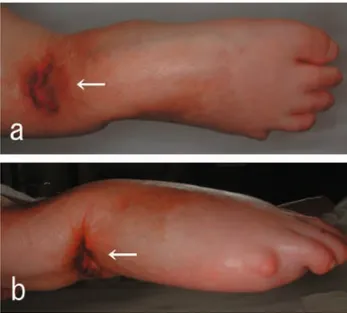 Figure 2. Histopathological features of the eccrine porocarcinoma on the anterior surface of the right foot