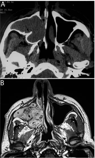FIGURE 2. Plain CT (A) and contrast-enhanced T1-weighted spin- spin-echo MR image (B), both on an axial plane