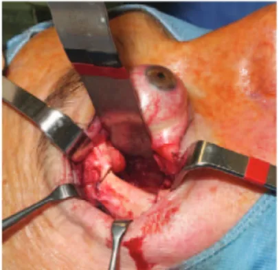 FIGURE 6. Twenty minutes after injecting the sclerosant, a right compartment syndrome took place