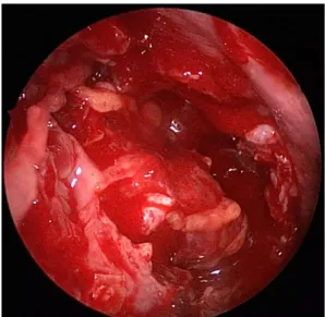 Fig. 1. Intra-operative endoscopic image showing the complete removal of the fractured lamina papyracea