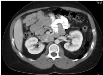 FIGURE 1. CT scan of the abdomen/pelvis with intravenous contrast demonstrating retroperitoneal free air and diverticulosis of the  trans-verse colon.