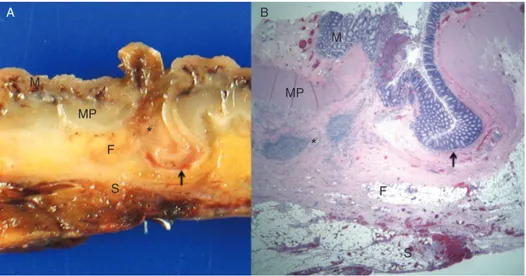 FIGURE 2. Gross and microscopic images of an inflamed diverticulum with evidence of perforation