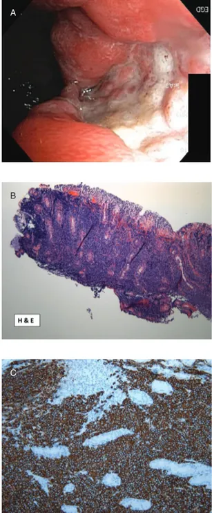 FIGURE 1. A, Deep gastric ulcer in the fundus. B, Gastric biopsy showing extensive lymphoid infiltrate within mucosa with gland destruction (H&amp;E stain, original magnification 10)
