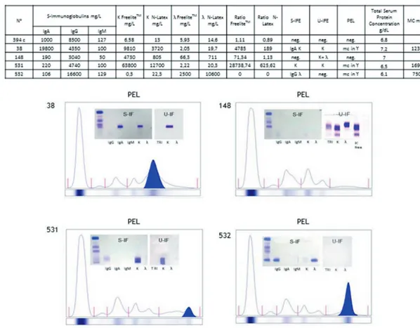 Figure 5. Monoclonal samples characterization. FLC quantification (with both the N Latex FLC and the Freelite TM assays), IgA, IgG and IgM quantification, serum (S-IFE) and urine (U-IFE) immunofixation, total protein concentration, monoclonal band densitom