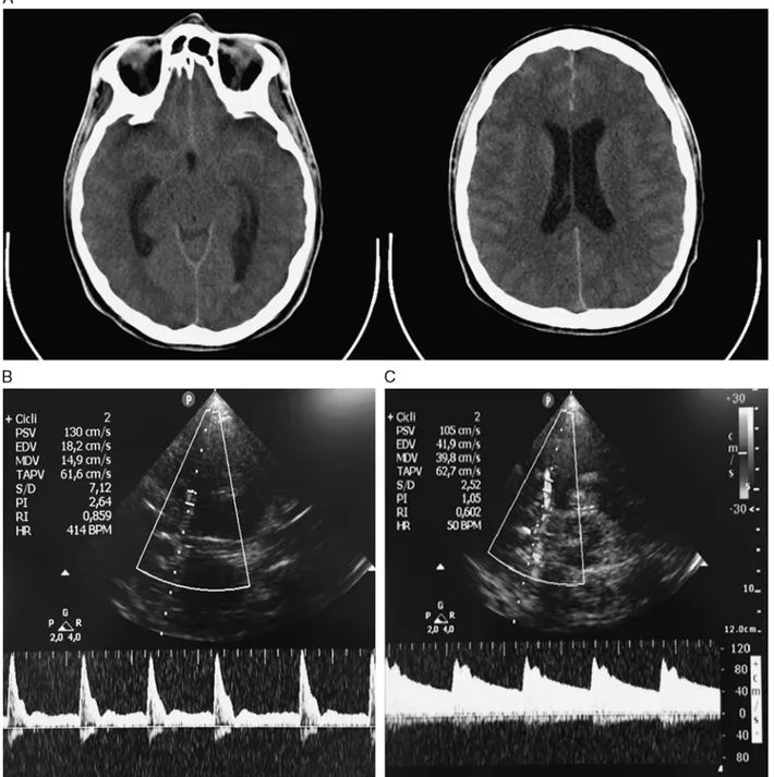 FIGURE 1. A, Bilateral subarachnoid hemorrhage in the cerebral sulci, basal cisterns, perivascular spaces, left posterior ventricular horn and in the third ventricle; initial signs of mild hydrocephalus of the temporal horns