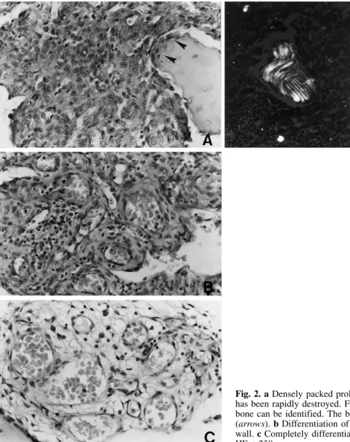 Fig. 2. a Densely packed proliferating cells in an area where bone has been rapidly destroyed