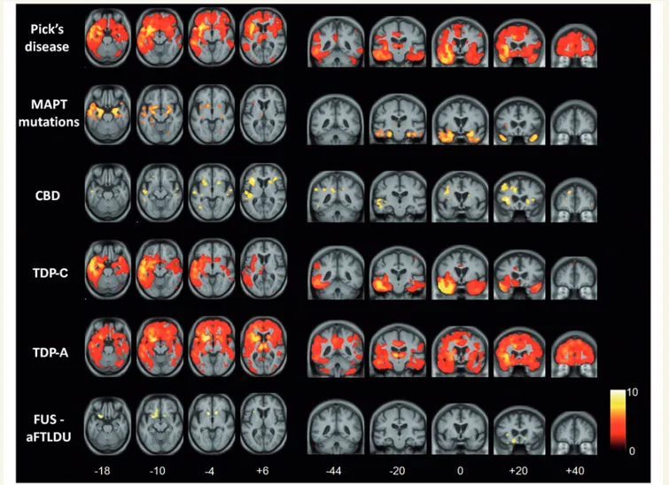 Figure 2 Voxel-based morphometry analysis on grey matter regions in FTLD pathological groups relative to healthy controls