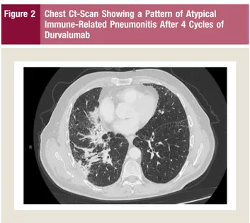 Figure 1 Total-Body Ct Scan was Performed 15 Days After Radio-Chemotherapy, Showing Partial Response Of Disease