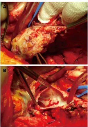 Figure 2  Extraction of the thrombus through a cavotomy (A) and exami- exami-nation of the caval lumen in a completely bloodless field (B).