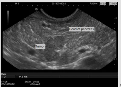 Figure 1. Endoscopic ultrasonography showing a 14.3 mm lesion in the head of the pancreas