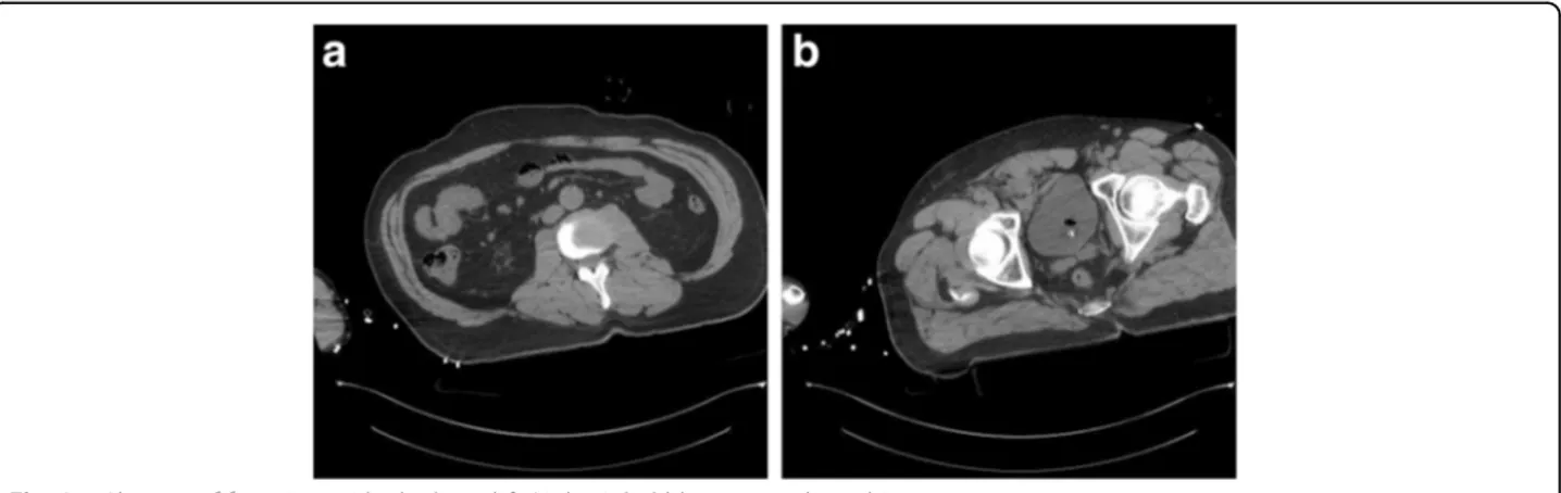 Fig. 4 a Presence of peritoneal air bubbles outside the bowel. b Hematoma near the pubisFig