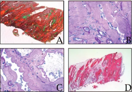 Figure 2. (A) Kidney biopsy specimen showing extensive peritubular and interstitial amyloid deposition in the inner medulla