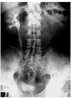 FIGURE 3. Urography after 60 months.  DISCUSSION 