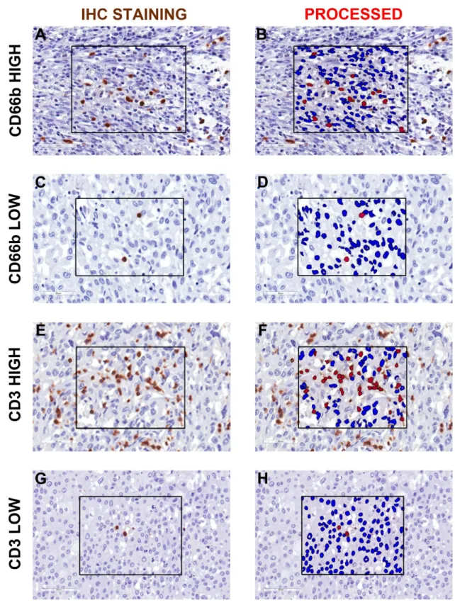 Figure 1. Representative image analysis for CD66b +  TAN and CD3 +  T cells in human MIBC
