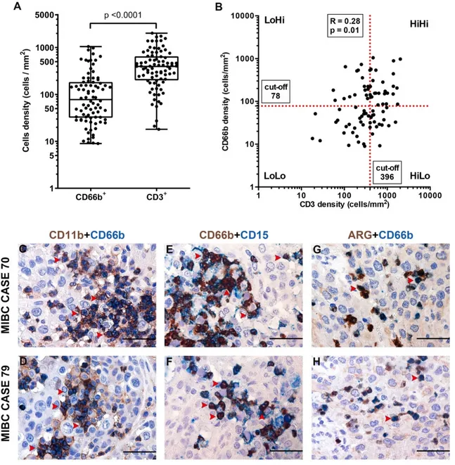 Figure 2. Density of CD66b +  TAN and CD3 +  T cells and phenotype of TAN in human MIBC