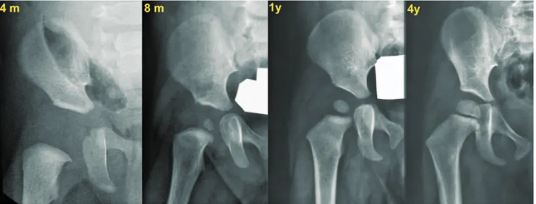 FIGURE 5 Radiographic aspects of the expansion of the proximal femur ossification center, which maintains the spherical shape from age 8 months to 4 years: (A) age 4 months; (B) age 8 months;