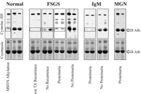Figure 2. Titration of the Cys 34 free SH groups of albumin in FSGS, IgM, and membranous glomerulonephritis (MGN)