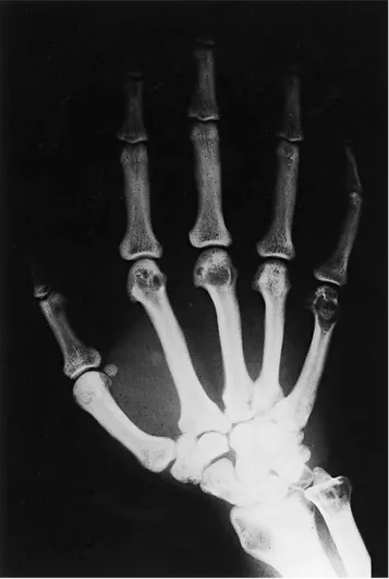 Fig. 3 . Roentgenograms of the left hand show the same kind of lytic lesions in the distal ends of radius and ulna, carpal bones, metacarpals and proximal phalanges.