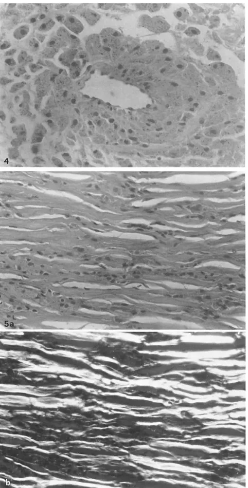 Fig  4  Mononuclear  histiocytes with many  black  particles   sur-rounding  a vessel  H&amp;E;  x 300