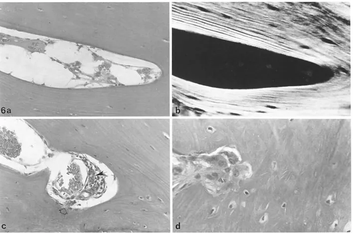 Fig  6 a-d  Relationships  between  mononuclear  histiocytes  and  bone;  H&amp;E  a  Mononuclear  histiocytes  with  black  inclusions  inside