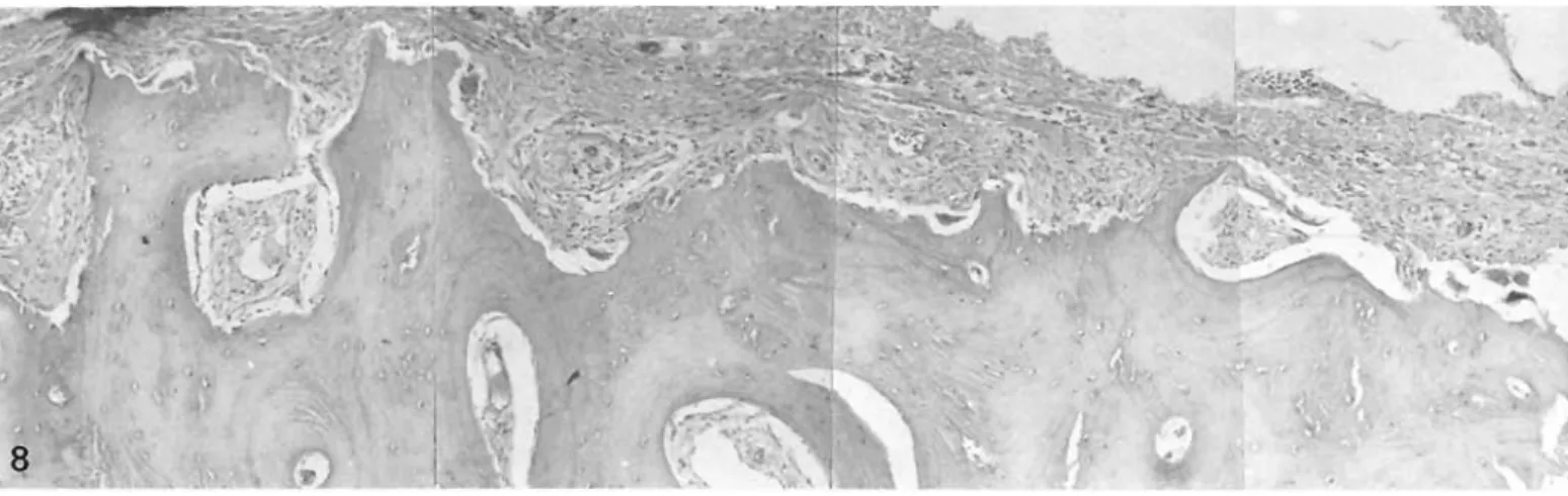 Fig  8  Tissue  between  diaphyseal  bone  and cement  (but  not from the  calcar)  of prosthesis  PM  Many osteoclasts  are  present on  the