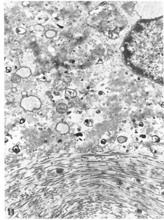 Fig  11  Transmission  electron  microscopy  A  mononuclear histiocyte  in  very