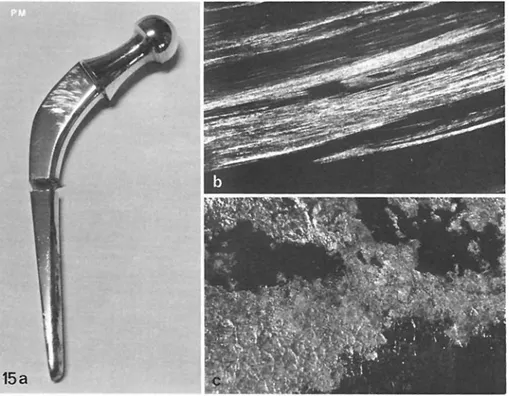 Fig  15 a-c  a Charnley  stainless-