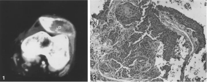 Fig. 1. Computerized tomography shows destruction of the patella with invasion of soft tissues 