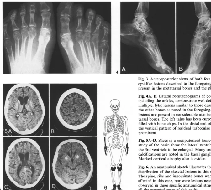 Fig. 3.  Anteroposterior  views of both  feet  show  the  cyst-like lesions  described  in  the  foregoing to  be  present  in  the  metatarsal  bones  and  the  phalanges  Fig
