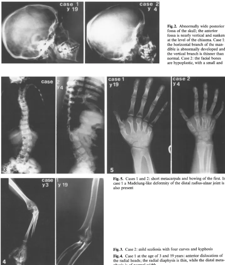 Fig. 5.  Cases  I  and  2:  short metacarpals  and  bowing  of the  first.  In  case 1  a  Madelung-like  deformity of the  distal  radius-ulnar joint is  also  present 
