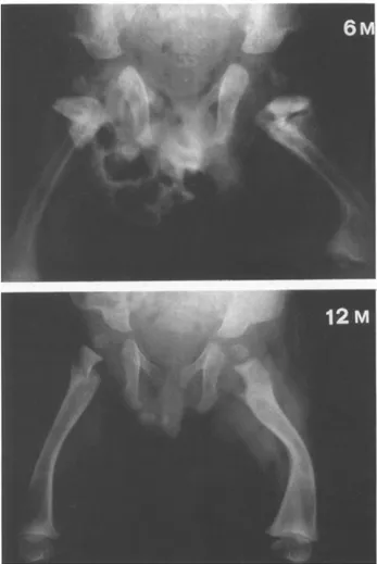 Fig. 1.  Case  1. Evolution of radiographic changes in femura from  6 month  to  1 year  of  age