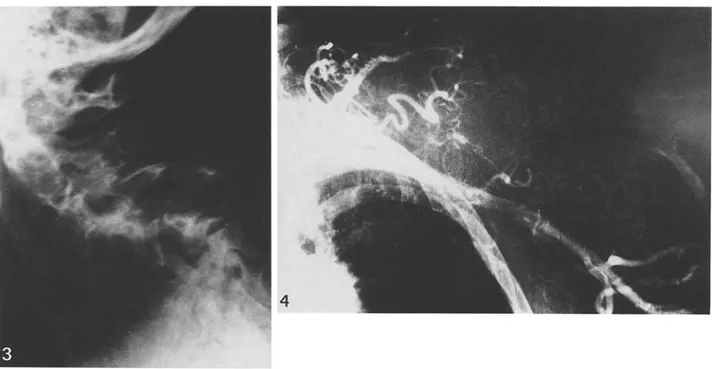 Fig. 3.  Acute  kyphosis  of the  cervical  spine  due  to  collapse  of the  5th  a n d   6th  vertebrae 