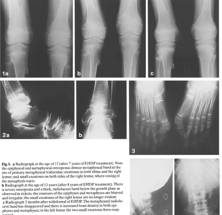 Fig. 1.  a Radiograph at the age of 12 (after 7 years of EHDP treatment). Note  the epiphyseal and metaphyseal osteopenia; denser metaphyseal band at the  site of primary metaphyseal trabeculae; exostoses in both tibiae and the right  femur; and small exos