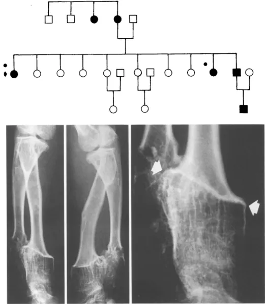 Fig. 3.  E R A., 12-years-old, 6 family  members with HME. Antero-posterior  and lateral views of the forearm showing  a fail-thickness exostosis of the distal,  radial metaphysis