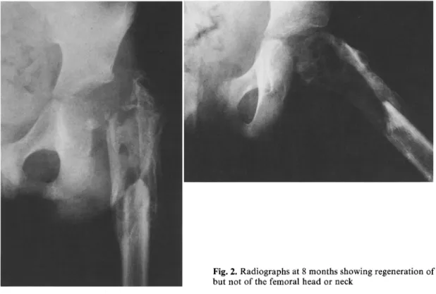 Fig. 2.  Radiographs  at 8 months  showing regeneration of the proximal shaft,  but  not  of the  femoral head  or  neck 