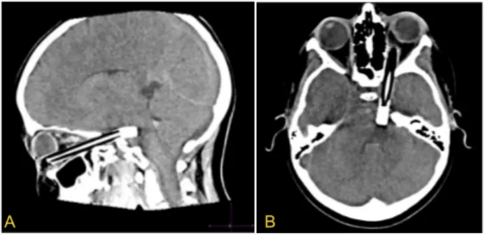 Figure 1. Computed Tomography (CT) scan showing the presence of an 
