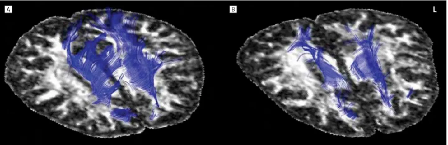 Figure 4. Diffusion tensor imaging in a representative control subject (A) and a patient with corticobasal degeneration syndrome (B) illustrates the selective fiber tract changes