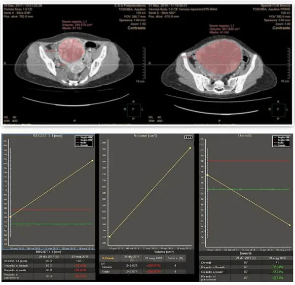Figure  1.  Disagreement  in  response  assessment  within  the  three  criteria:  according  to  Choi,  the  decrease in tumor attenuation was evaluated as a partial response, while according to both Volume  and RECIST 1.1 its increase in planar dimension