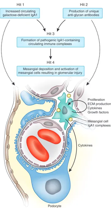 Figure 2. Proposed pathways involved in the pathogenesis of IgAN: multi-hit mechanism