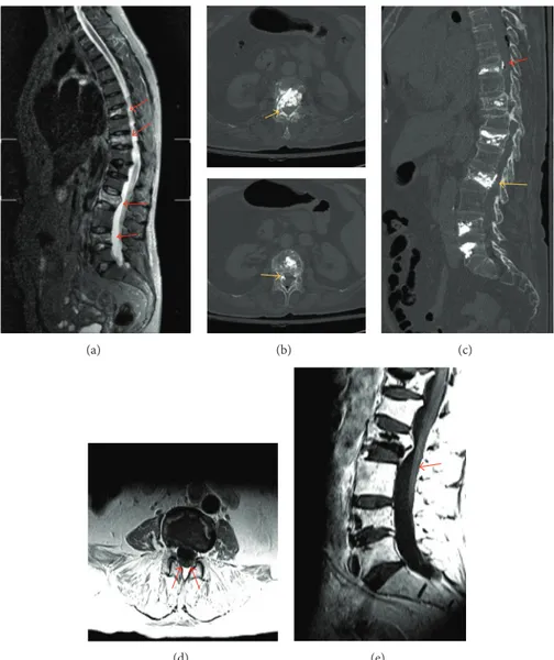 Figure 1: (a) Preinterventional STIR MRI showing acute D8, D10, L2, and L4 vertebral body fracture (red arrows)
