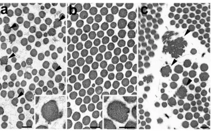 Figure 2. Electron micrographs of the reticular dermis of skin biopsy from proband 1 (a), proband 2 (b) and a case of classical EDS (c)